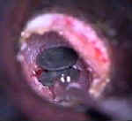 Ear Tube Insertion With Instrumentarium Hand Stable Instruments