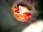 stapedectomy_mcgee_crimper.jpg (26353 bytes)